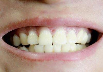 洗牙对牙齿有伤害吗（洗牙对牙齿有损害吗?多久洗一次?）